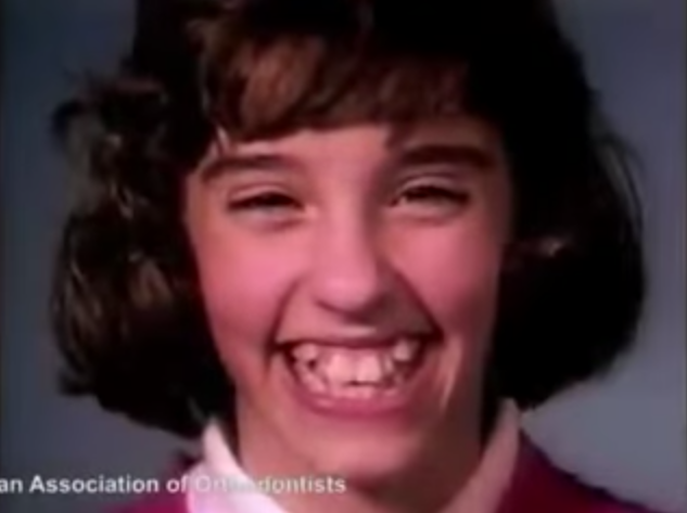 Impresionante video muestra cómo cambian los dientes con frenillos