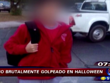 Operan por segunda vez a niño que quedó con el rostro desfigurado en Halloween