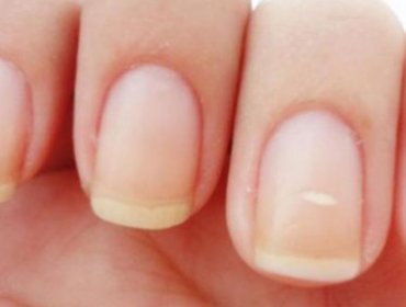 ¿Por qué tenemos manchitas blancas en las uñas?