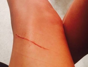Taylor Swift sufrió “arañazó” en su asegurada y millonaria pierna