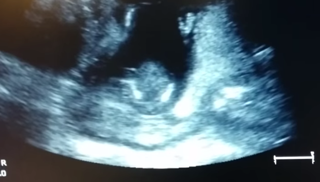 Impresionante: Feto de 14 semanas aplaude durante una ecografía