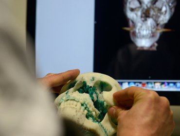 Transplantan a una niña de tres años un cráneo hecho en impresora 3D