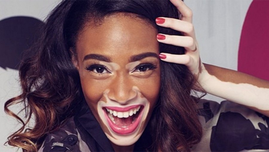 Maquillarse como la modelo con vitíligo, la nueva tendencia en Instagram