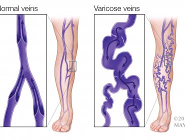 ¿Son peligrosas las venas varicosas o son sólo un problema estético?