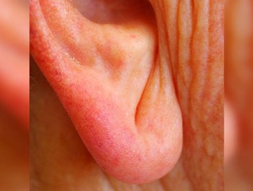 Atento con estas pequeñas imperfecciones en tu oreja que pueden ser una señal de que no estás bien