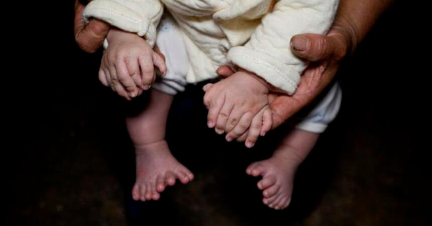 Bebé nació con 31 dedos y sus padres se enfrentan a la decisión de operarlo o no