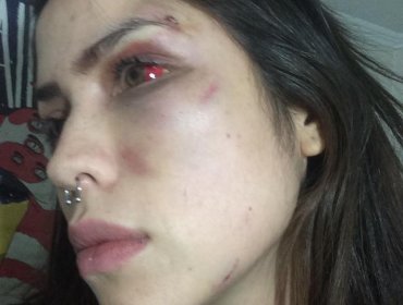 Grave denuncia por brutal golpiza hace pareja de vocalista de Los Tetas