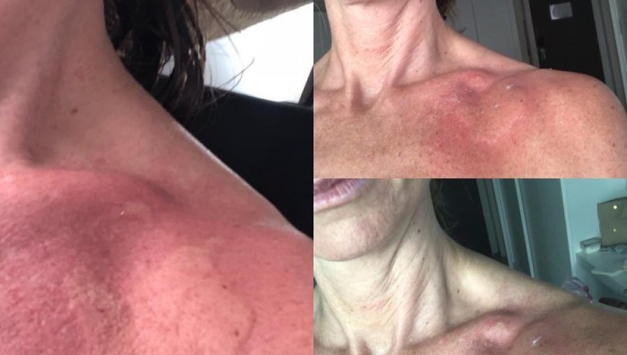 Así quedó la actriz María José Prieto de Perdona Nuestros Pecados tras ser picada por una medusa