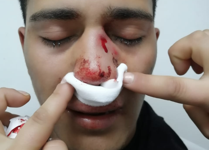 Joven viñamarino denuncia que fue brutalmente atacado por ser homosexual