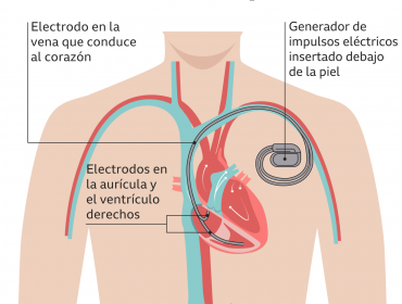 Cómo funciona el desfibrilador que le implantarán en el corazón a Christian Eriksen