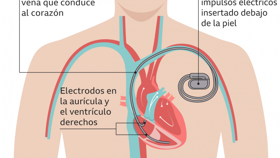 Cómo funciona el desfibrilador que le implantarán en el corazón a Christian Eriksen