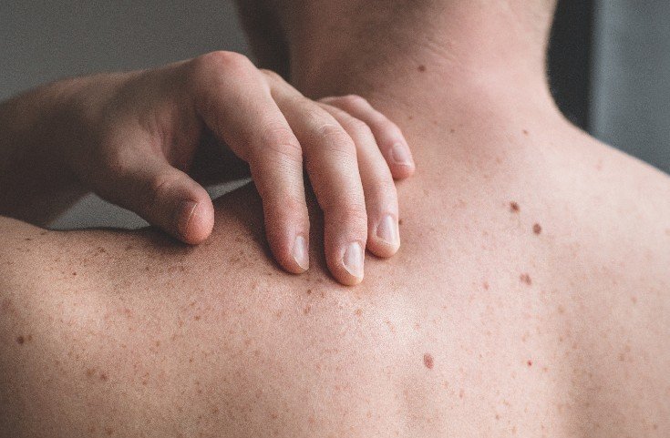 Mortalidad por cáncer de piel aumentó entre 50% y 100% en la última década