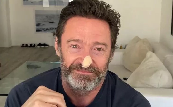 Hugh Jackman se sometió a dos nuevas biopsias en la nariz ante un nuevo riesgo de cáncer de piel