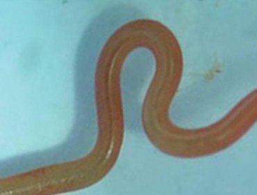 Científicos encontraron por primera vez un gusano vivo en el cerebro de una mujer en Australia