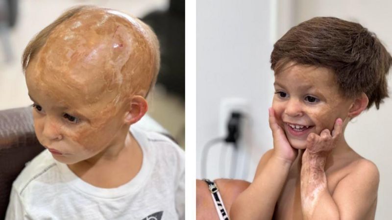 La inspiradora historia del peluquero brasileño que les devuelve la autoestima a los niños que perdieron el pelo en accidentes