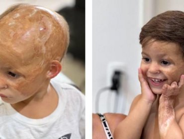 La inspiradora historia del peluquero brasileño que les devuelve la autoestima a los niños que perdieron el pelo en accidentes