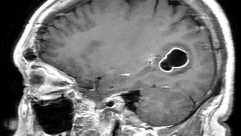 Descubren que fuertes migrañas que sufría un hombre en EE.UU. eran causadas por larvas que tenía en su cerebro