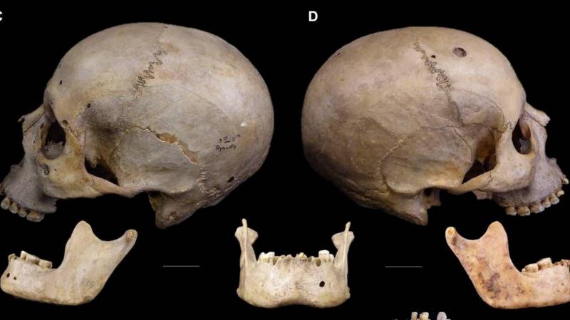 Cráneo de 4 mil años de antigüedad revela cómo los egipcios trataron de operar el cáncer