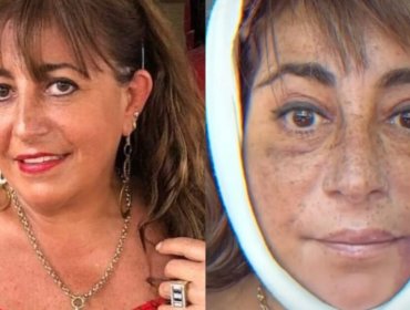 Helhue Sukni y su cirugía facial: "Mi doctor me sacó la cara y me la volvió a poner"