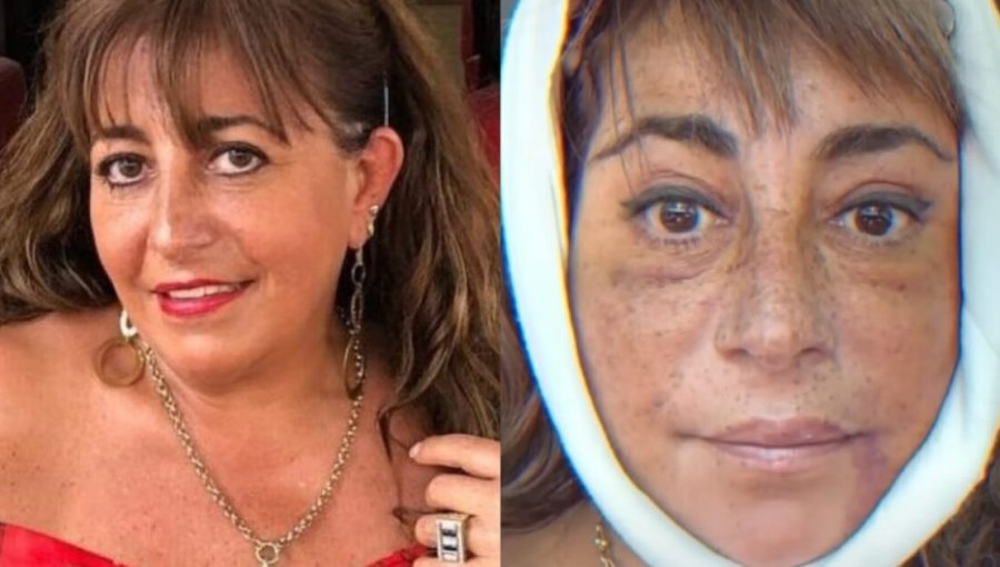 Helhue Sukni y su cirugía facial: "Mi doctor me sacó la cara y me la volvió a poner"