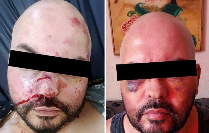 Denuncian ataque homofóbico a hombre en Los Andes: tres sujetos le propinaron golpes de pies y puño en su rostro