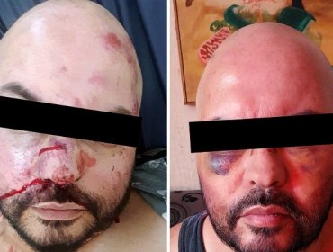 Denuncian ataque homofóbico a hombre en Los Andes: tres sujetos le propinaron golpes de pies y puño en su rostro