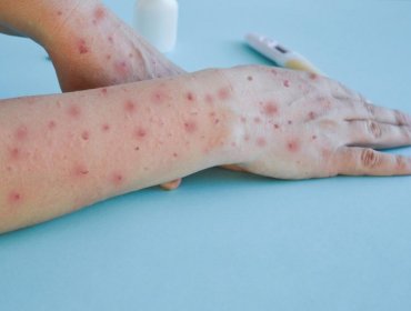 OMS declara el fin de la emergencia sanitaria internacional por viruela del mono, pero mantiene la alerta en África
