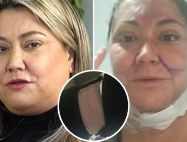 Denisse Campos rompe el silencio y asegura que sus intervenciones estéticas son para ingresar a un reality: "Yo no quiero decaer físicamente"