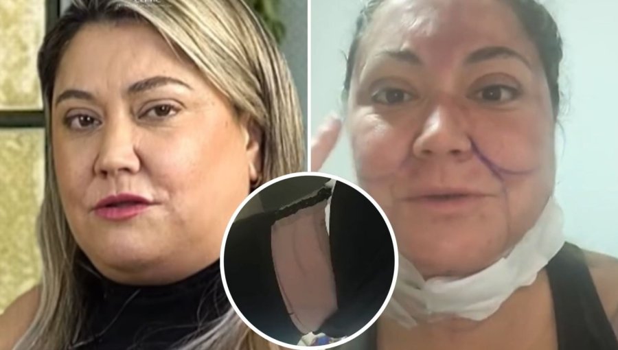 Denisse Campos rompe el silencio y asegura que sus intervenciones estéticas son para ingresar a un reality: "Yo no quiero decaer físicamente"