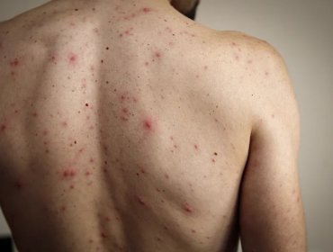 Minsal confirma caso importado de sarampión en la región Metropolitana: Paciente se encuentra en buen estado de salud
