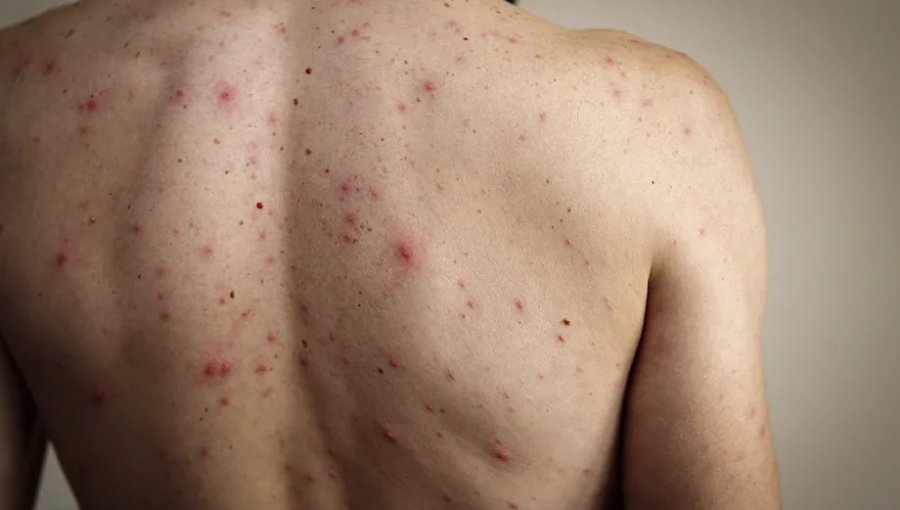 Minsal confirma caso importado de sarampión en la región Metropolitana: Paciente se encuentra en buen estado de salud