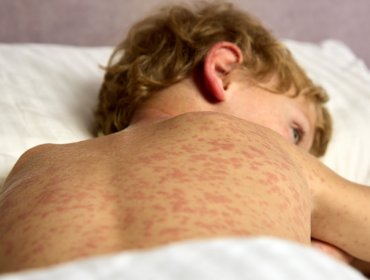 Aumento internacional de brotes de sarampión enciende las alarmas en Viña del Mar