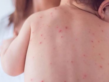 Minsal confirma caso importado de sarampión en Chile: se trata de un lactante de 11 meses con antecedentes de viaje a México