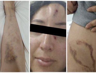 Brutales agresiones con cuchillos, palos y extintores siembran el terror en funcionarios de residencia familiar de Quillota