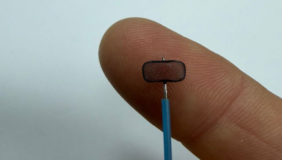 Hospital Van Buren de Valparaíso implementa innovador tratamiento para aneurismas cerebrales rotos