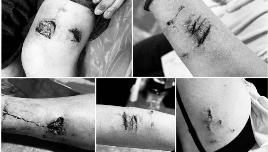 Segundo ataque de jauría en menos de 24 horas en Laguna Verde: hombre fue mordido en brazos y piernas tras proteger a sus hijos