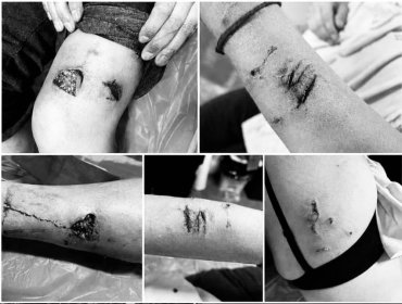 Segundo ataque de jauría en menos de 24 horas en Laguna Verde: hombre fue mordido en brazos y piernas tras proteger a sus hijos
